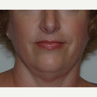 Liposuction before 3345878