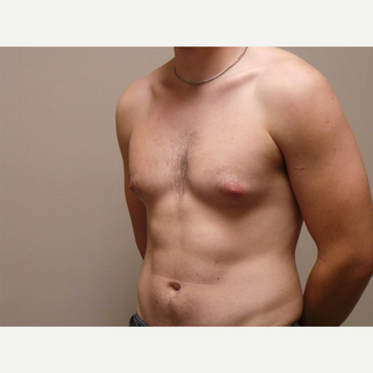 25-34 year old man treated with Male Breast Reduction before 3454694