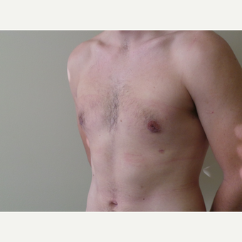 25-34 year old man treated with Male Breast Reduction after 3454694