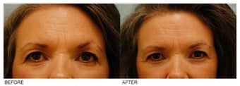 Eyebrow Hair Transplant before 134783