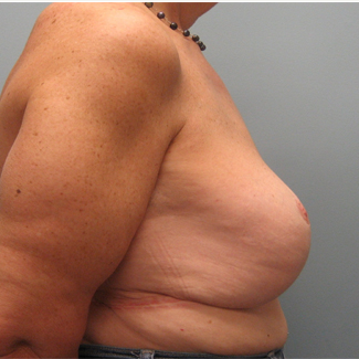 Body Lift after 3680277