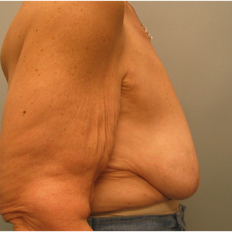 Body Lift before 3680277