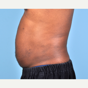 25-34 year old man treated with Liposuction after 3810104