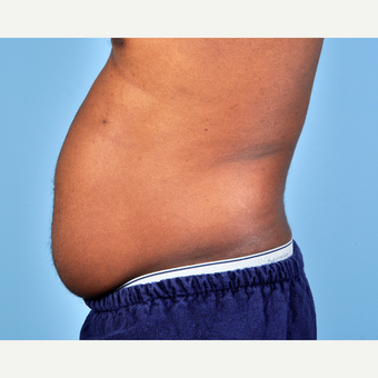 25-34 year old man treated with Liposuction before 3810104