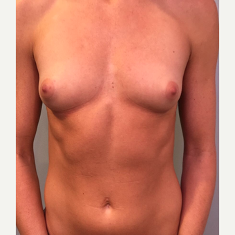 25-34 year old woman treated with Breast Augmentation before 3530447