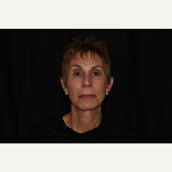 65-74 year old woman treated with Fractional Laser before 3025690