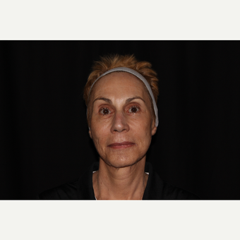 65-74 year old woman treated with Fractional Laser after 3025690