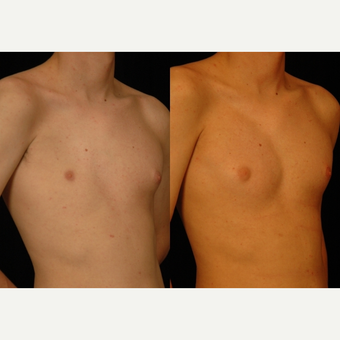 18-24 year old man treated with Pec Implants after 3659576