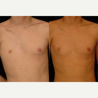 18-24 year old man treated with Pec Implants before 3659576