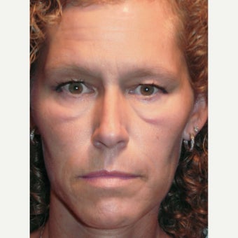 44 year old woman treated with Eye Bags Treatment and Laser Eyelid Surgery before 1933115