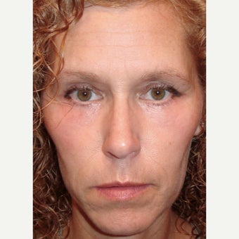 44 year old woman treated with Eye Bags Treatment and Laser Eyelid Surgery after 1933115