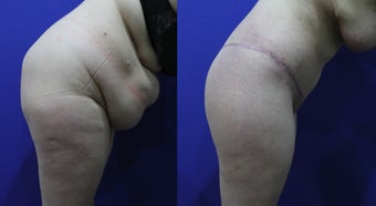 32 Year Old Female Treated for Abdominal Apron & Sagging Buttocks before 1109120