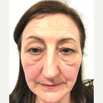 Eye Bags Treatment before 3767266