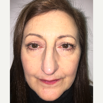 Eye Bags Treatment after 3767266
