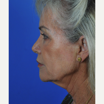 Facelift and neck lift before 3340727