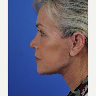 Facelift and neck lift after 3340727