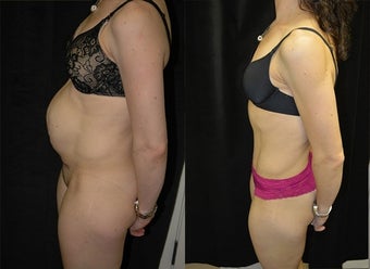 Tummy Tuck before 3037970