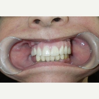 55-64 year old woman treated with All-on-4 Dental Implants after 2454725