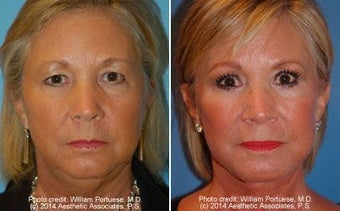 Facelift before 339350