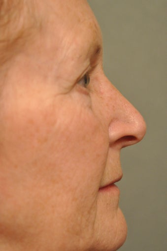 66 year old female treated for sun damage and wrinkles 927780