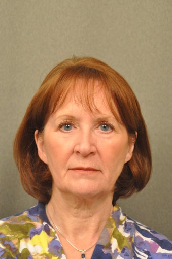 66 year old female treated for sun damage and wrinkles after 927780