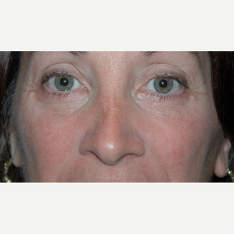 44 year old woman treated with Eyelid Surgery after 3710581