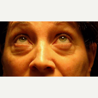 44 year old woman treated with Eyelid Surgery before 3710581