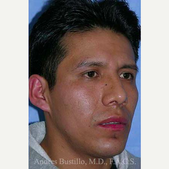 29 year old man treated with Rhinoplasty after 3460974