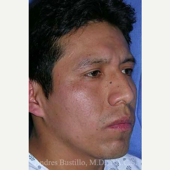 29 year old man treated with Rhinoplasty before 3460974