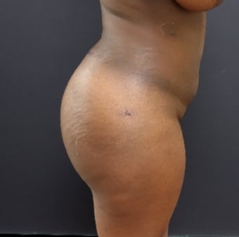 25-34 year old woman treated with Fat Transfer after 3363862
