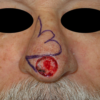 55-64 year old man treated with Mohs Surgery on the nose before 3183941