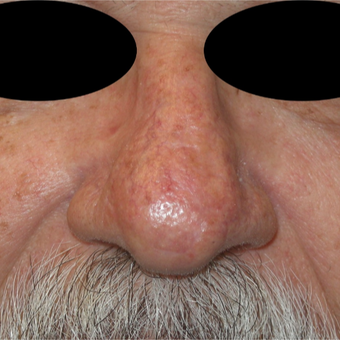 55-64 year old man treated with Mohs Surgery on the nose after 3183941
