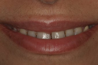 Smile Makeover with 8 Porcelain Veneers before 206796