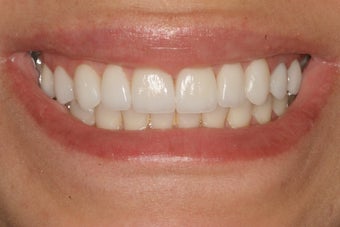 Smile Makeover with 8 Porcelain Veneers after 206796