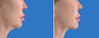 Ultherapy before 1214287