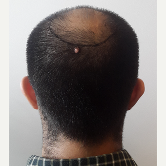 18-24 year old man treated with FUE Hair Transplant before 3729988