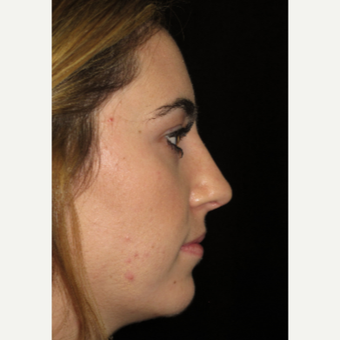 Scarless Closed Rhinoplasty after 3586229