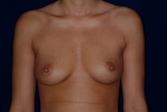 Breast Augmentation before 336266