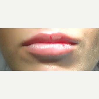18-24 year old woman treated with Belotero after 3744579