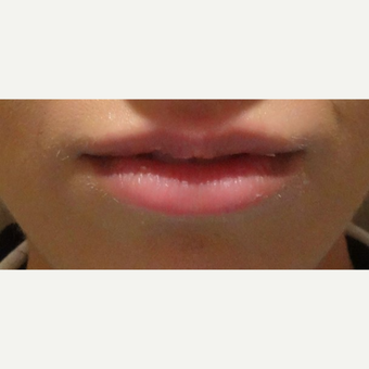 18-24 year old woman treated with Belotero before 3744579