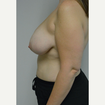 25-34 year old woman treated with Breast Reduction before 3141064