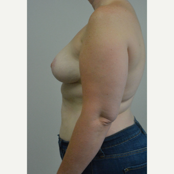 25-34 year old woman treated with Breast Reduction after 3141064