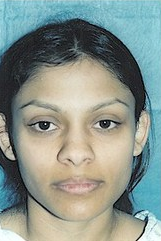 Otoplasty before 251844