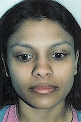 Otoplasty after 251844
