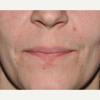 Facial Filler to Lower Face after 3374991