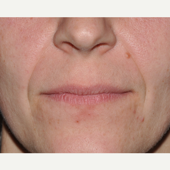Facial Filler to Lower Face before 3374991
