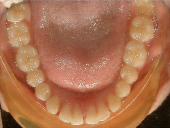 Invisalign treatment for spaced out teeth 881799