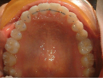Invisalign treatment for spaced out teeth after 881799