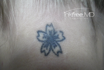 25-34 year old woman treated with Laser Tattoo Removal before 3779014
