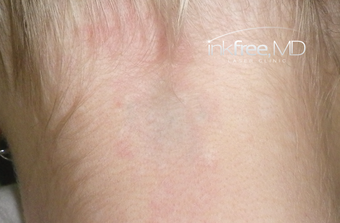 25-34 year old woman treated with Laser Tattoo Removal after 3779014